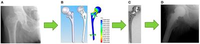 Current Trends in Improving of Artificial Joints Design and Technologies for Their Arthroplasty